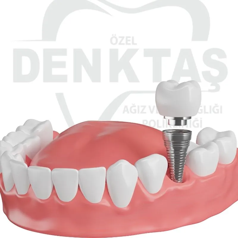 Tek Diş İmplant