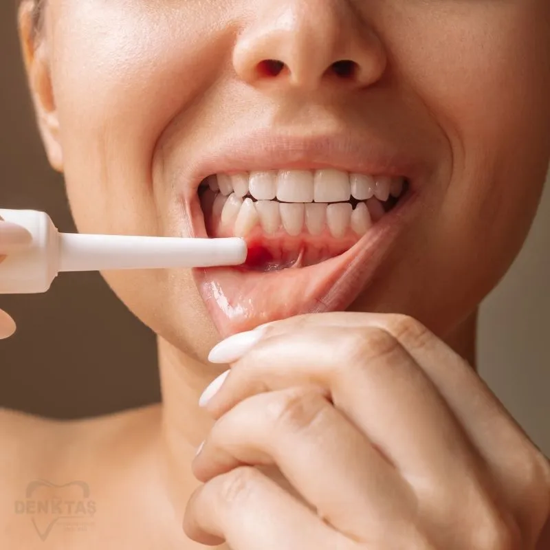 Periodontoloji: Diş Eti Hastalıklarının Tedavisi ve Bakımı